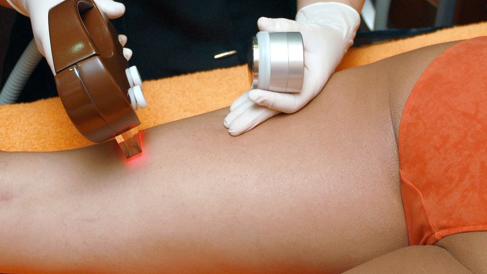 laser hair removal