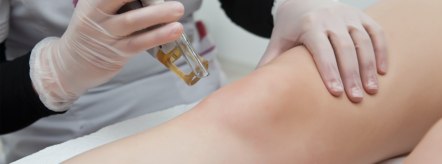 Laser Hair Removal Procedure
